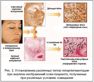Рис. 2. Установление различных типов гиперпигментации при анализе изображений кожи пациента, полученных при различных условиях освещения
