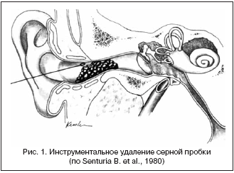 Рис. 1. Инструментальное удаление серной пробки (по Senturia B. et al., 1980)