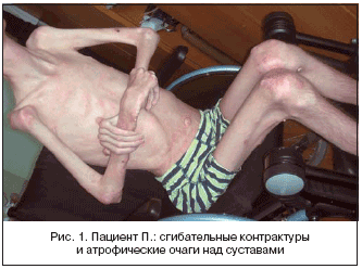 Рис. 1. Пациент П.: сгибательные контрактуры и атрофические очаги над суставами