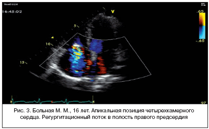 Рис. 3. Больная М. М., 16 лет. Апикальная позиция четырехкамерного сердца. Регургитационный поток в полость правого предсердия