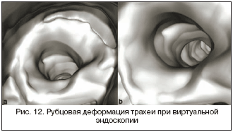 Рис. 12. Рубцовая деформация трахеи при виртуальной эндоскопии