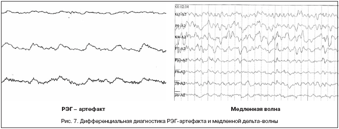 Рис. 7. Дифференциальная диагностика РЭГ-артефакта и медленной дельта-волны
