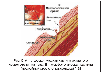 Рис. 5. A – эндоскопическая картина активного кровотечения из язвы; B – морфологическая картина (послойный срез стенки желудка) [13]