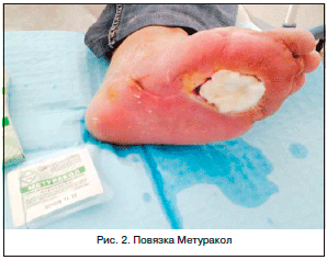 Опыт применения коллагеновых повязок и губок Метуракол в хирургической практике