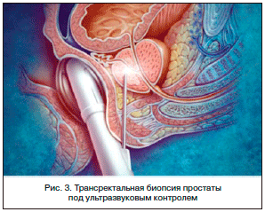 Дифференциальная диагностика рака и доброкачественной гиперплазии предстательной железы