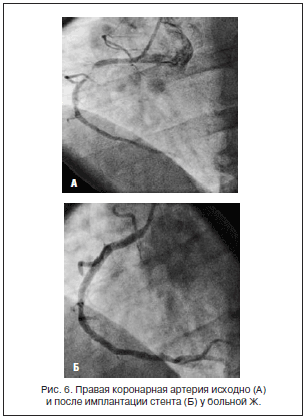 Рис. 6. Правая коронарная артерия исходно (А) и после имплантации стента (Б) у больной Ж.