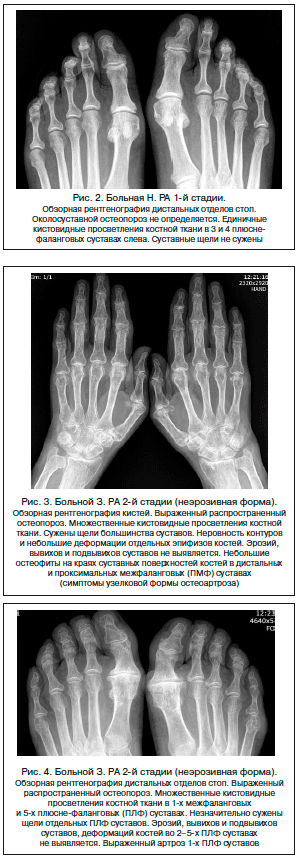 Стадии рентгенологических изменений в суставах при ревматоидном артрите