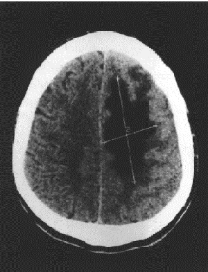 Рис. 1. Магнитно-резонансная томограмма больного Б. Очаг ишемического инфаркта в левой лобновисочно-теменной области размером 77х43х50 мм.