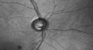 Глаукома при нормальном глазном давлении лечение
