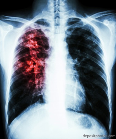 Проживающие с больными туберкулезом лица резистентны к инфекции 