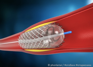 Длительность двойной антитромбоцитарной терапии после стентирования коронарных артерий