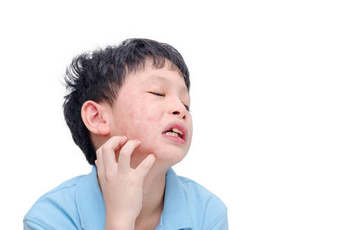 Особенности клинической картины и течения острых аллергических реакций (крапивницы и отека Квинке) у детей