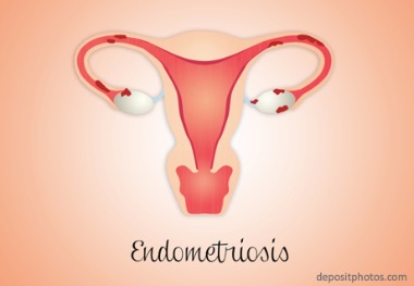 Европейское общество репродукции человека и эмбриологии обновило клинические рекомендации по ведению пациенток с эндометриозом . Рис. №1