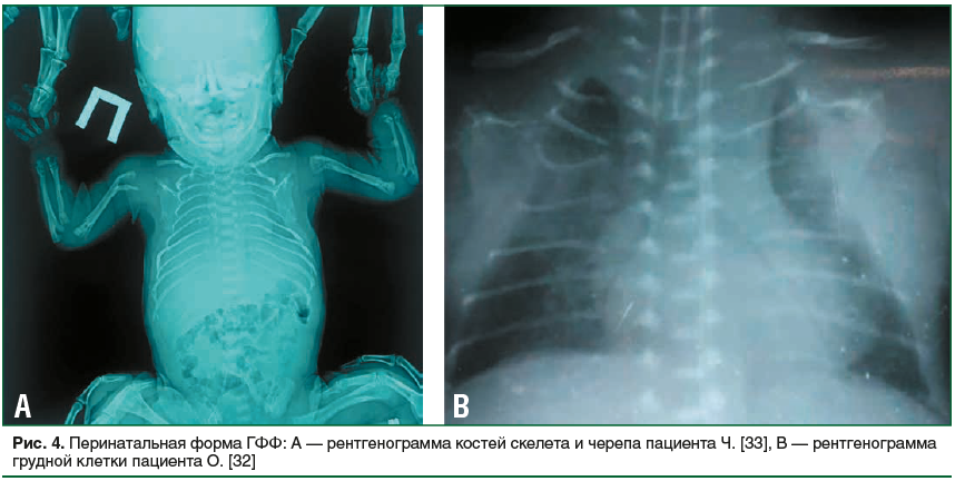 Рис. 4. Перинатальная форма ГФФ: А — рентгенограмма костей скелета и черепа пациента Ч. [33], В — рентгенограмма грудной клетки пациента О. [32]