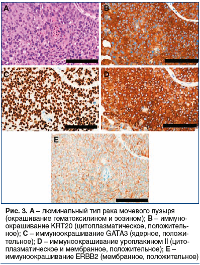 Рис. 3. A – люминальный тип рака мочевого пузыря (окрашивание гематоксилином и эозином); B – иммуноокрашивание KRT20 (цитоплазматическое, положитель- ное); C – иммуноокрашивание GATA3 (ядерное, положительное); D – иммуноокрашивание уроплакином II (цитопла