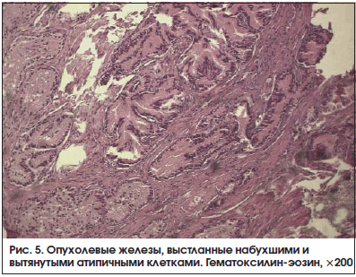 Рис. 5. Опухолевые железы, выстланные набухшими и вытянутыми атипичными клетками. Гематоксилин-эозин, ×200