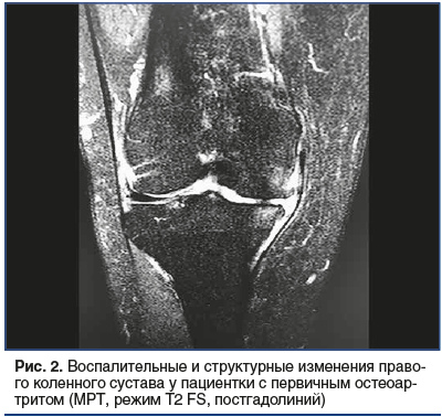 Рис. 2. Воспалительные и структурные изменения право- го коленного сустава у пациентки с первичным остеоартритом (МРТ, режим Т2 FS, постгадолиний)