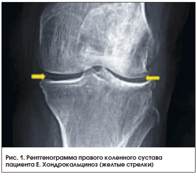 Рис. 1. Рентгенограмма правого коленного сустава пациента Е. Хондрокальциноз (желтые стрелки)