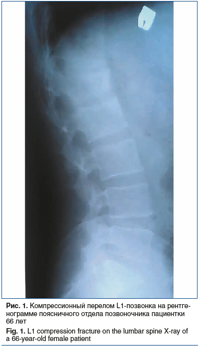 Рис. 1. Компрессионный перелом L1-позвонка на рентгенограмме поясничного отдела позвоночника пациентки 66 лет Fig. 1. L1 compression fracture on the lumbar spine X-ray of a 66-year-old female patient