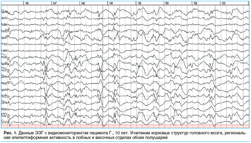 Рис. 1. Данные ЭЭГ с видеомониторингом пациента Г., 10 лет. Угнетение корковых структур головного мозга, региональ- ная эпилептиформная активность в лобных и височных отделах обоих полушарий