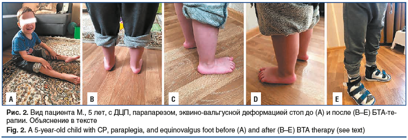 Рис. 2. Вид пациента М., 5 лет, с ДЦП, парапарезом, эквино-вальгусной деформацией стоп до (A) и после (B–E) БТА-терапии. Объяснение в тексте Fig. 2. A 5-year-old child with CP, paraplegia, and equinovalgus foot before (A) and after (B–E) BTA therapy (see 