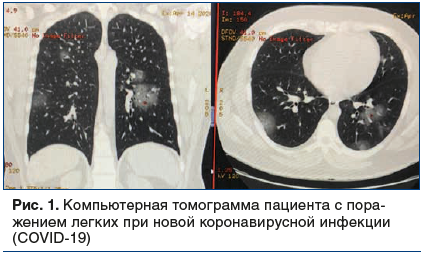 Рис. 1. Компьютерная томограмма пациента с поражением легких при новой коронавирусной инфекции (COVID-19)
