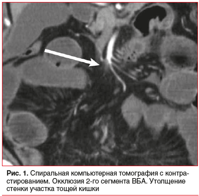 Рис. 1. Спиральная компьютерная томография с контра- стированием. Окклюзия 2-го сегмента ВБА. Утолщение стенки участка тощей кишки