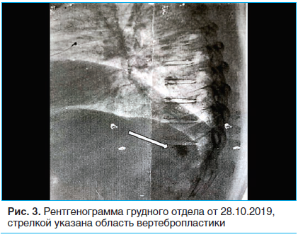 Рис. 3. Рентгенограмма грудного отдела от 28.10.2019, стрелкой указана область вертебропластики