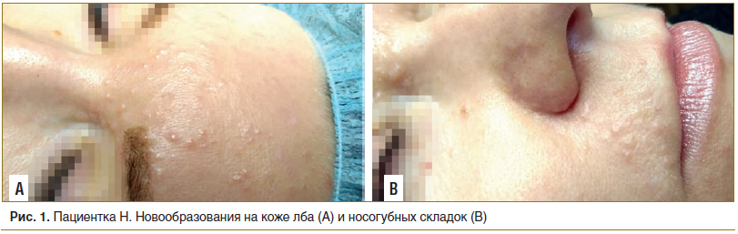 Рис. 1. Пациентка Н. Новообразования на коже лба (А) и носогубных складок (В)