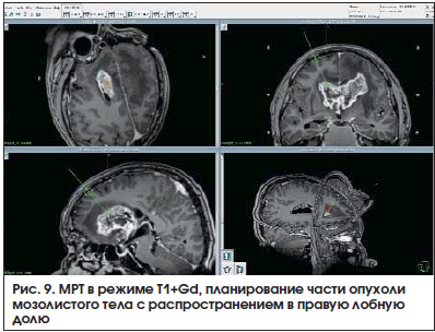 Рис. 9. МРТ в режиме T1+Gd, планирование части опухоли мозолистого тела с распространением в правую лобную долю