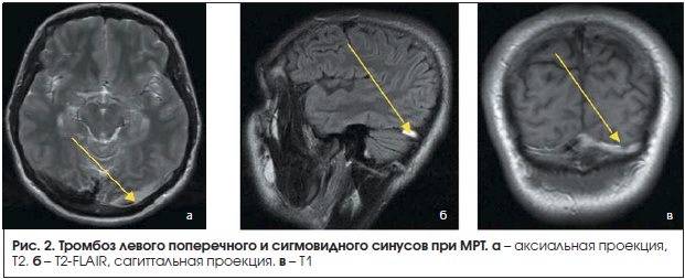 Рис. 2. Тромбоз левого поперечного и сигмовидного синусов при МРТ.