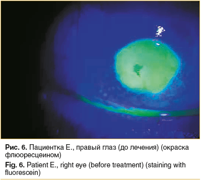 Рис. 6. Пациентка Е., правый глаз (до лечения) (окраска флюоресцеином)