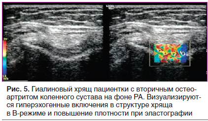Рис. 5. Гиалиновый хрящ пациентки с вторичным остеоартритом коленного сустава на фоне РА. Визуализируются гиперэхогенные включения в структуре хряща в В-режиме и повышение плотности при эластографии