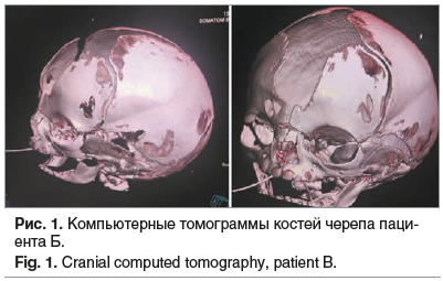 Рис. 1. Компьютерные томограммы костей черепа паци- ента Б. Fig. 1. Cranial computed tomography, patient B.