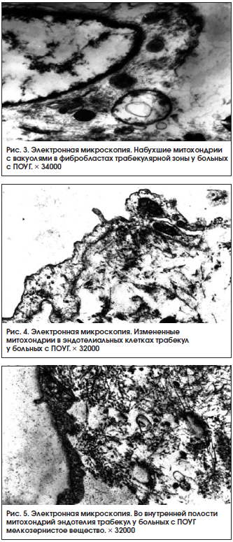 Рис. 3. Электронная микроскопия. Набухшие митохондрии с вакуолями в фибробластах трабекулярной зоны у больных с ПОУГ. × 34000