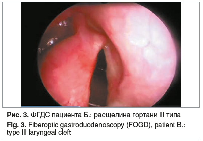 Рис. 3. ФГДС пациента Б.: расщелина гортани III типа Fig. 3. Fiberoptic gastroduodenoscopy (FOGD), patient B.: type III laryngeal cleft