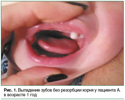 Рис. 1. Выпадение зубов без резорбции корня у пациента А. в возрасте 1 год