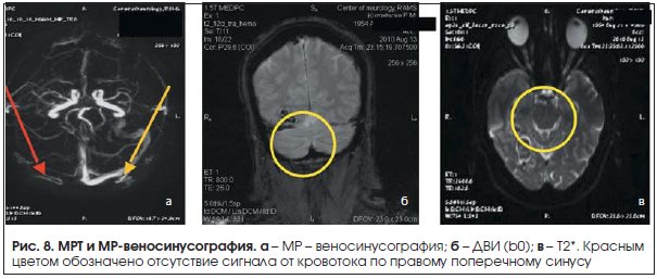 Рис. 8. МРТ и МР-веносинусография.