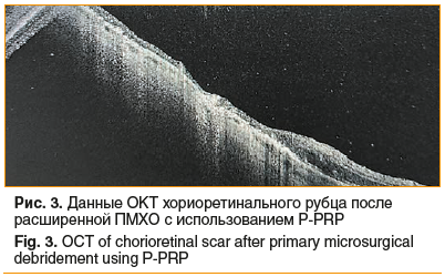 Рис. 3. Данные ОКТ хориоретинального рубца после расширенной ПМХО с использованием P-PRP Fig. 3. OCT of chorioretinal scar after primary microsurgical debridement using P-PRP