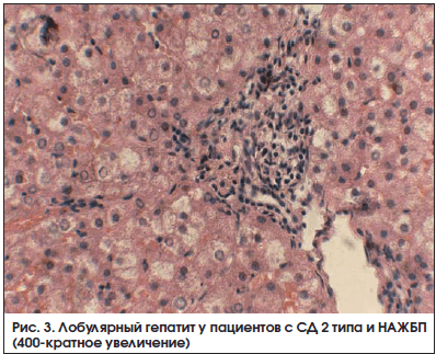 Рис. 3. Лобулярный гепатит у пациентов с СД 2 типа и НАЖБП (400-кратное увеличение)