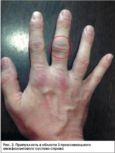 Оценка активности ревматоидного артрита thumbnail