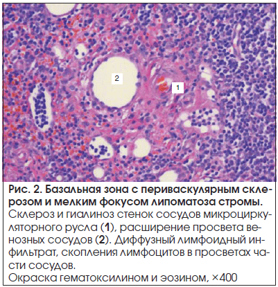 Рис. 2. Базальная зона с периваскулярным склерозом и мелким фокусом липоматоза стромы.