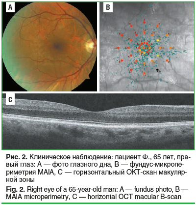 Рис. 2. Клиническое наблюдение: пациент Ф., 65 лет, правый глаз: А — фото глазного дна, В — фундус-микропериметрия MAIA, С — горизонтальный ОКТ-скан макуляр- ной зоны Fig. 2. Right eye of a 65-year-old man: A — fundus photo, B — MAIA microperimetry, C — h