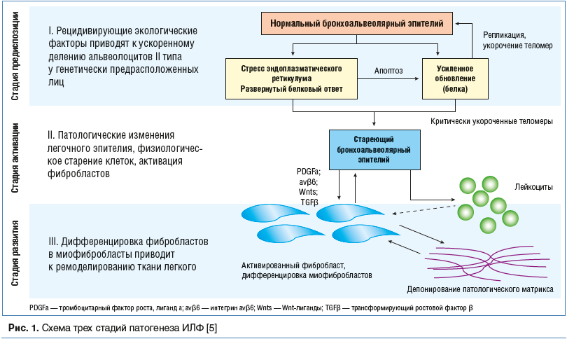 Рис. 1. Схема трех стадий патогенеза ИЛФ [5]