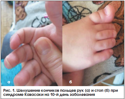 Рис. 1. Шелушение кончиков пальцев рук (а) и стоп (б) при синдроме Кавасаки на 10-й день заболевания