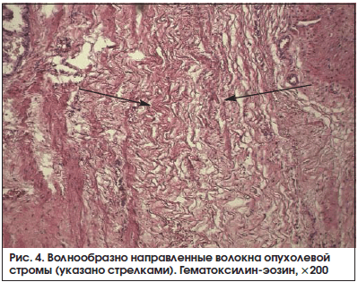 Рис. 4. Волнообразно направленные волокна опухолевой стромы (указано стрелками). Гематоксилин-эозин, ×200