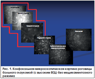 Рис. 1. Конфокальная микроскопическая картина роговицы больного глаукомой (с высоким ВГД) без медикаментозного режима