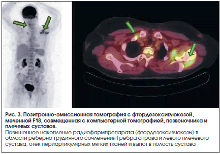Рис. 3. Позитронно-эмиссионная томография с фтордезоксиглюкозой, меченной F18, совмещенная с компьютерной томографией, позвоночника и плечевых суставов.