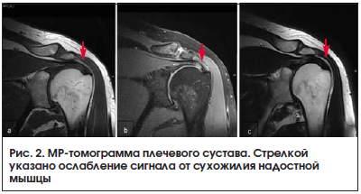 Рис. 2. МР-томограмма плечевого сустава. Стрелкой указано ослабление сигнала от сухожилия надостной мышцы