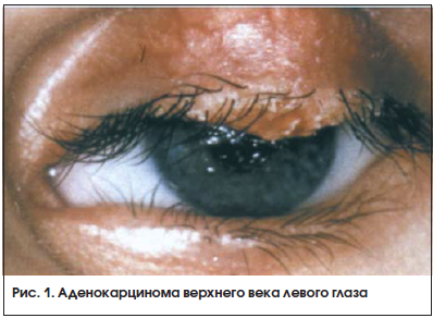 Рис. 1. Аденокарцинома верхнего века левого глаза